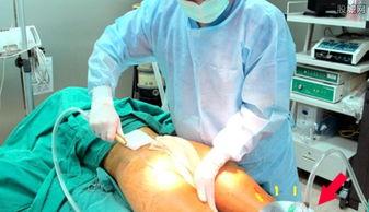 抽脂死亡事件明星网红,明星网红离世，整形美容安全警示录